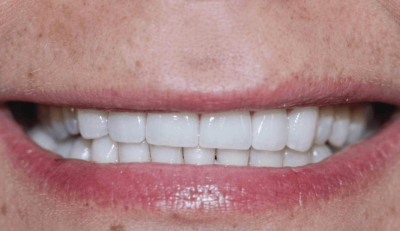 After Treatment