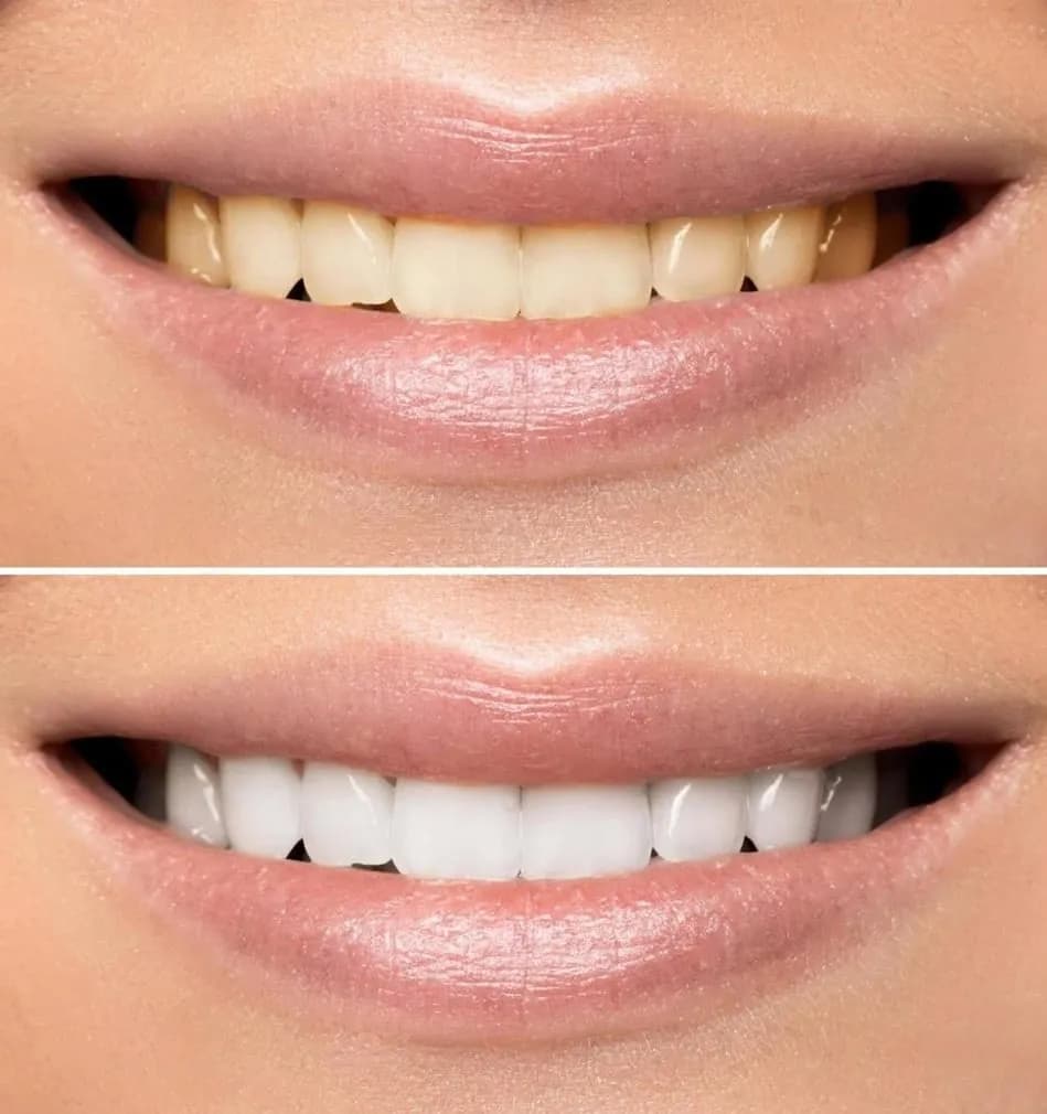 Professional teeth whitening before and after