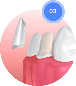 Veneer Placement