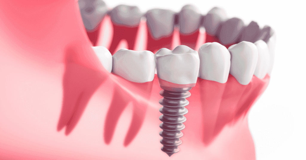 Porcelain veneer smile transformation