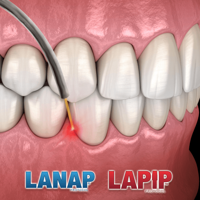 LANAP laser-assisted new attachment procedure