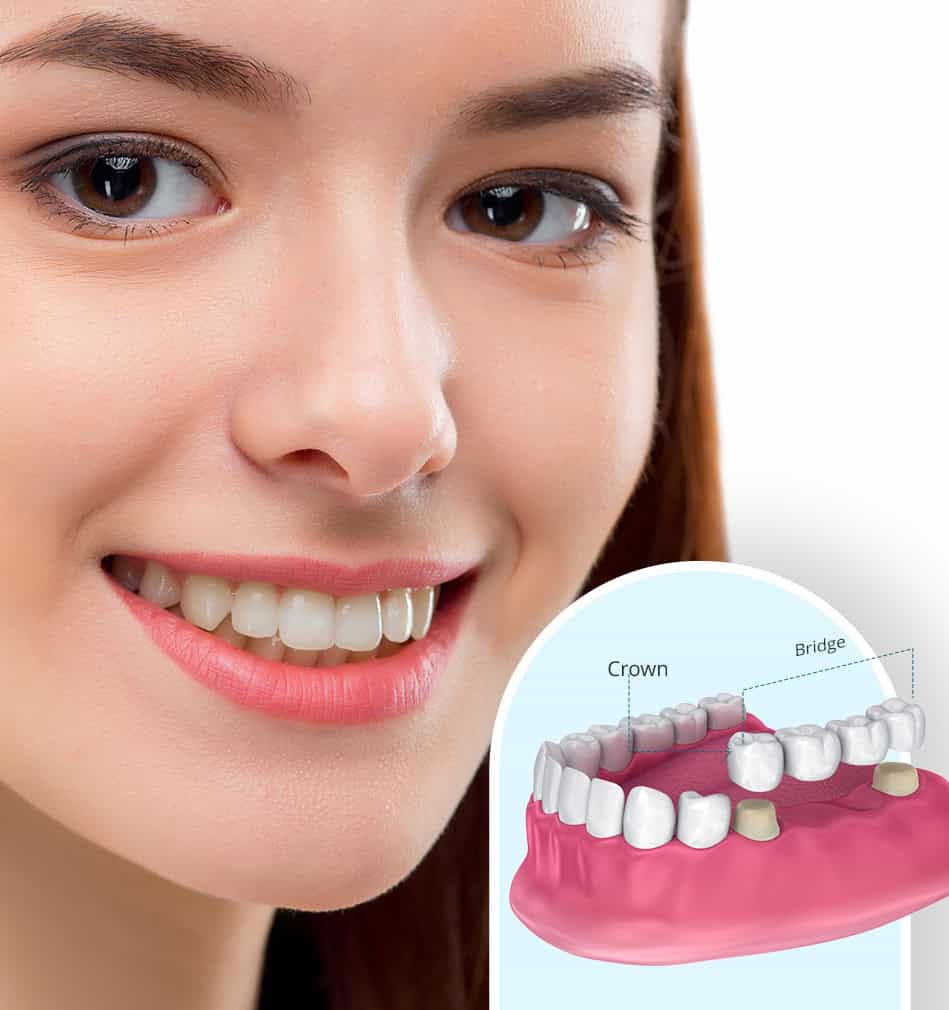 Natural-looking dental crowns and bridges used to restore damaged or missing teeth
